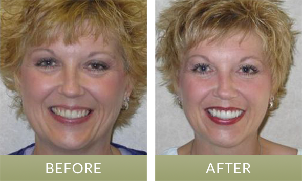 Patient who received dental from our cosmetic dentist in Fishers, IN, near Indianapolis and Noblesville