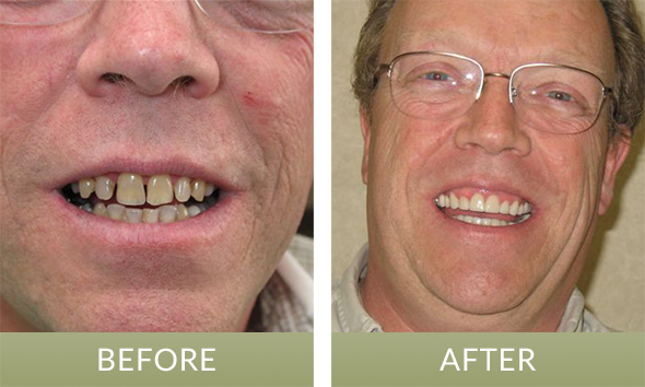 Indianapolis dentist patient received dental crowns and veneers at Pence Family Dentistry