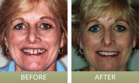 Indianapolis patient before and after having her smile fixed using a dental bridge.