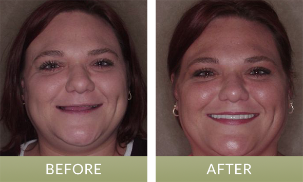 Indianapolis patient before and after receiving dental crowns near Indianapolis.