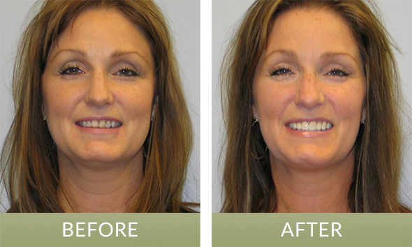 Patient who received porcelain dental veneers from our cosmetic dentist in Fishers, IN, near Indianapolis and Noblesville