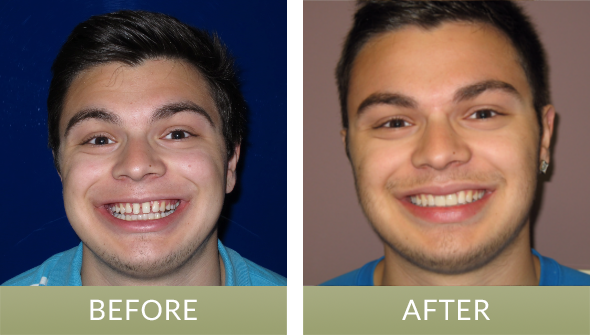 Dental patient who received orthodontic treatment and tooth veneers from our cosmetic dentist in Fishers, IN, near Indianapolis and Noblesville