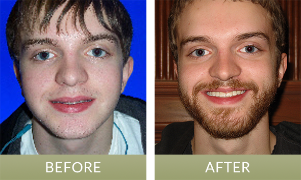 Indianapolis patient before and after undergoing dental implant surgery near Indianapolis.