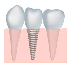 dental implants with a dentist Fishers