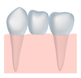 dental bridge options for missing teeth in Indianapolis