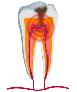 root canals for a toothache with a Fishers dentist Indianapolis