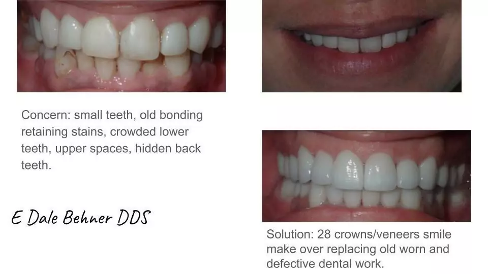 Smile Makeover with Indianaplois dentist before and after photo